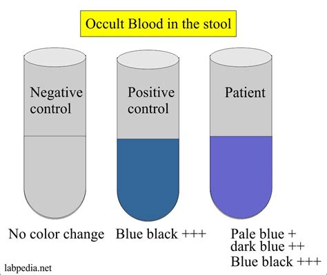 Positive Occult Blood in UC10: A New Approach to Early Disease Diagnosis